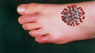 Covidové prsty jsou jedním z příznaků nemoci