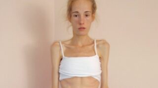 Gemma Walkerová porazila anorexii a poté bulimii