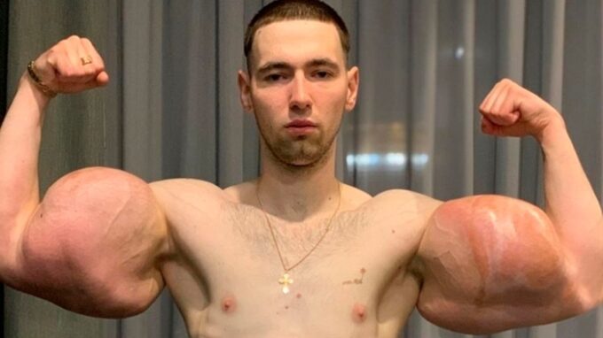 Kirill Tereshin lituje toho, že si napichoval svaly