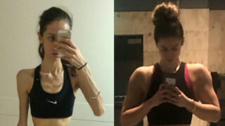 Mhairi Stewart měla v nejhorším období anorexie BMI 12