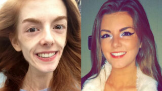 Annie Windleyová dokázala překonat anorexii