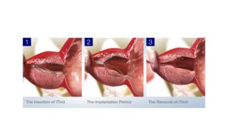 Studie prokázala, že léčba zvětšené prostaty pomocí přístroje iTind účinkuje déle než čtyři roky