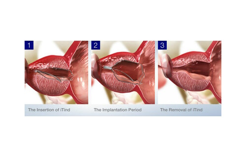 Studie prokázala, že léčba zvětšené prostaty pomocí přístroje iTind účinkuje déle než čtyři roky