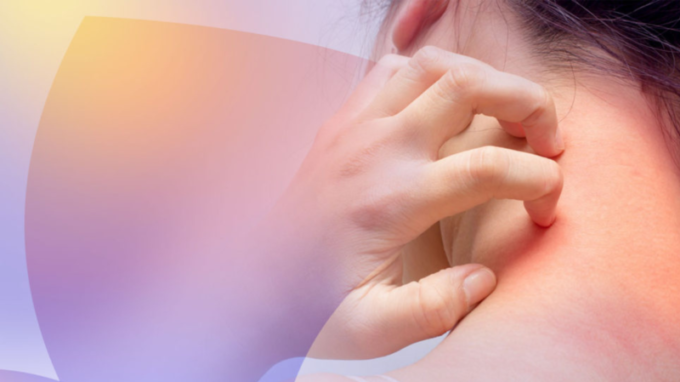 S ekzémem se v Česku léčí 234 tisíc pacientů. Onemocnění připomene Světový den atopické dermatitidy