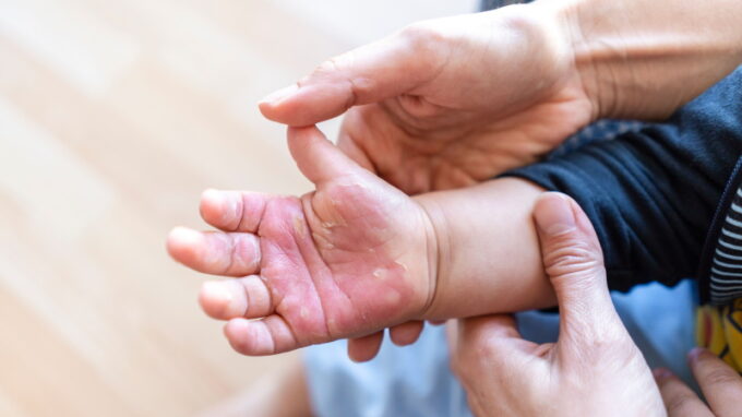 Popáleniny jsou rizikem nejvíce pro děti