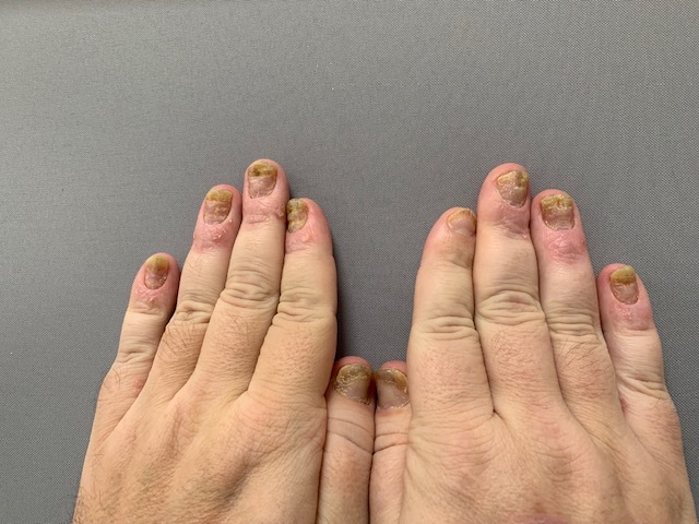 Světový den lupénky: Téměř polovina pacientů s psoriázou trpí úzkostí