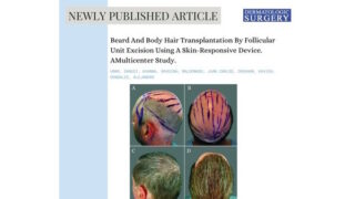 Nová technologie transformuje léčbu ztráty vlasů s využitím vousů a tělesného ochlupení