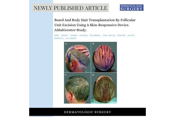 Nová technologie transformuje léčbu ztráty vlasů s využitím vousů a tělesného ochlupení